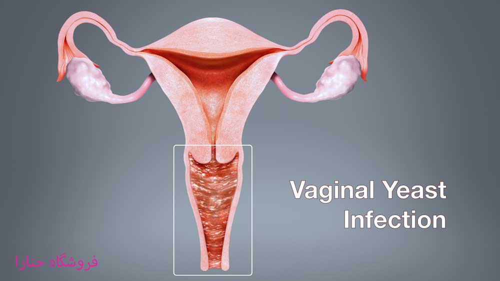 عفونت قارچی واژن