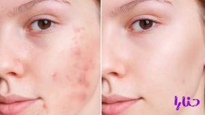 acne causes 300x168 - روشهای درمان سریع جوش زیرپوستی