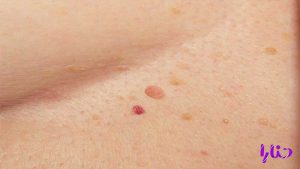 skin cancer 300x169 - آیا دستگاه لاک خشک کن باعث سرطان پوست میشود؟