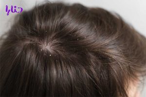 close up hair with dandruff 300x200 - 10 علت خارش سر و راههای درمان آن: