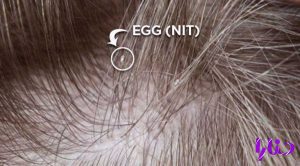 lice egg stuck to hair 1594 300x166 - راههای تشخیص شپش سر و درمان های موثر آن: