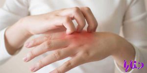 eczema 300x150 - 10 درمان خانگی موثر اگزمای پوستی: