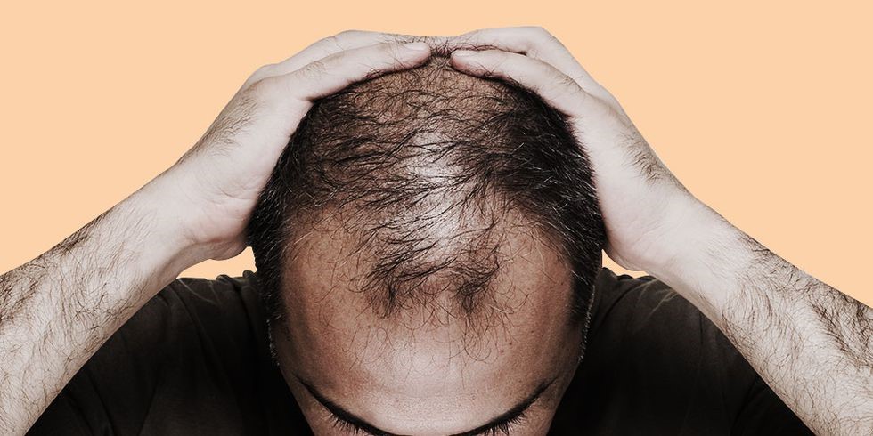 جلوگیری از ریزش مو حنارا - از بین بردن ریزش مو + علت تا درمان ریزش مو 😍