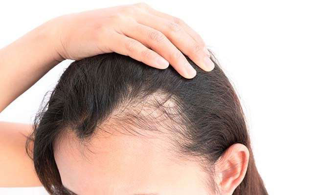 ریزش مو به صورت تخصصی حنارا - از بین بردن ریزش مو + علت تا درمان ریزش مو 😍
